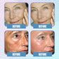 Hyaluronic Acid Microcrystalline Lifting Decree Patch